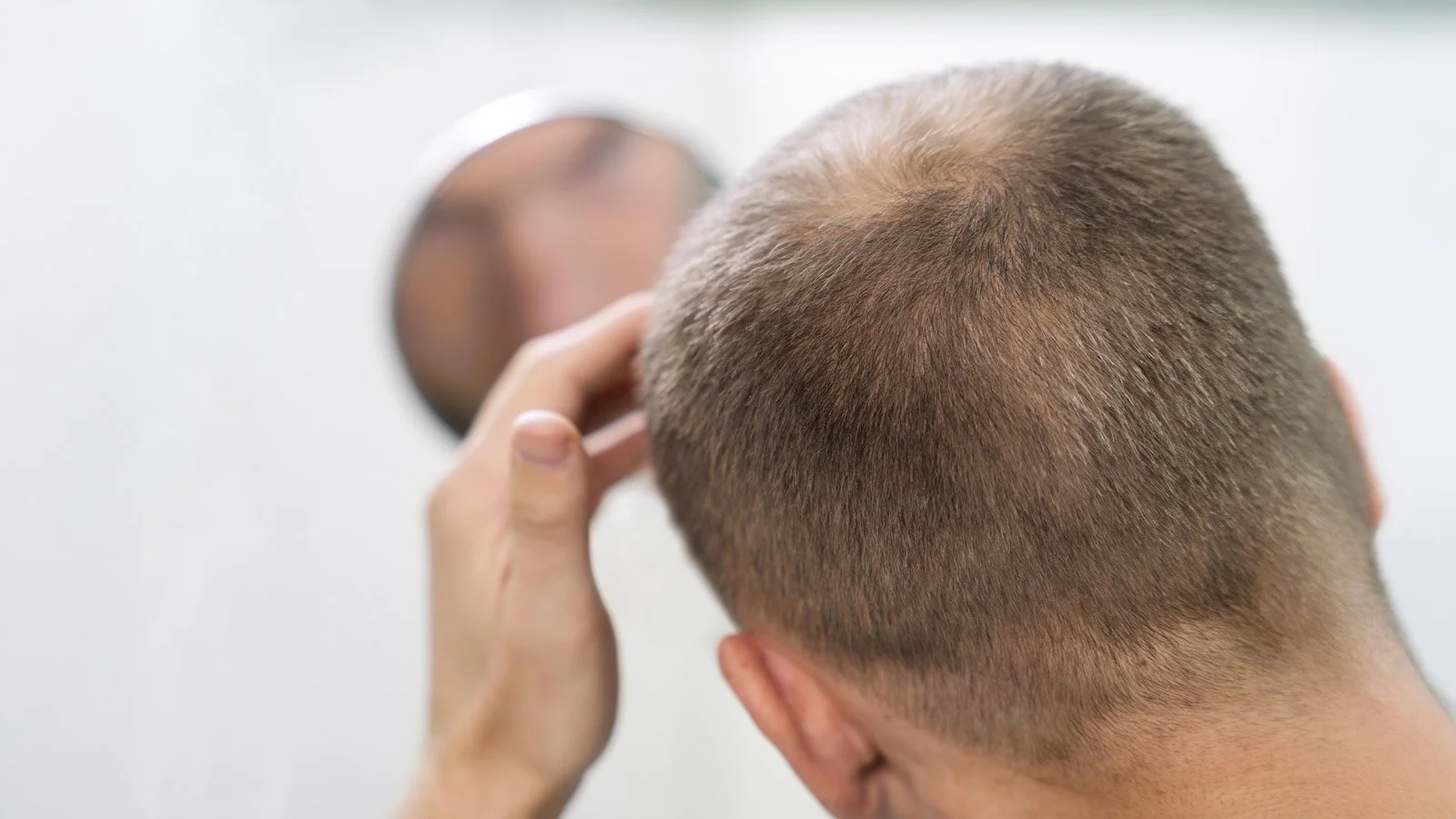 Adult male having balding problems