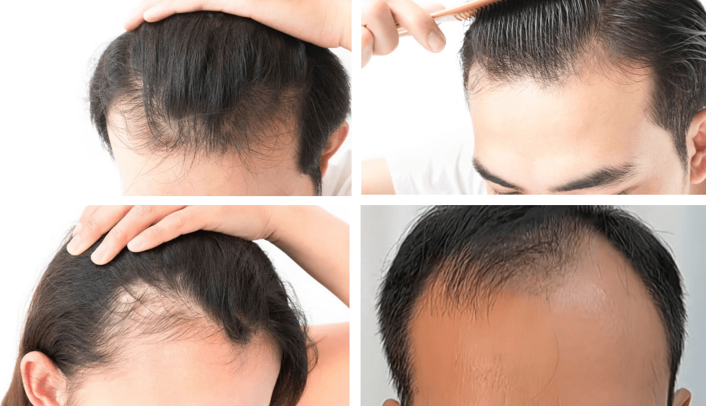 Image of various stages of hair loss